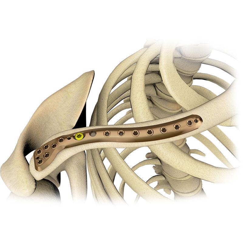 Пластина для дистального відділу ключиці 5.0ChLP